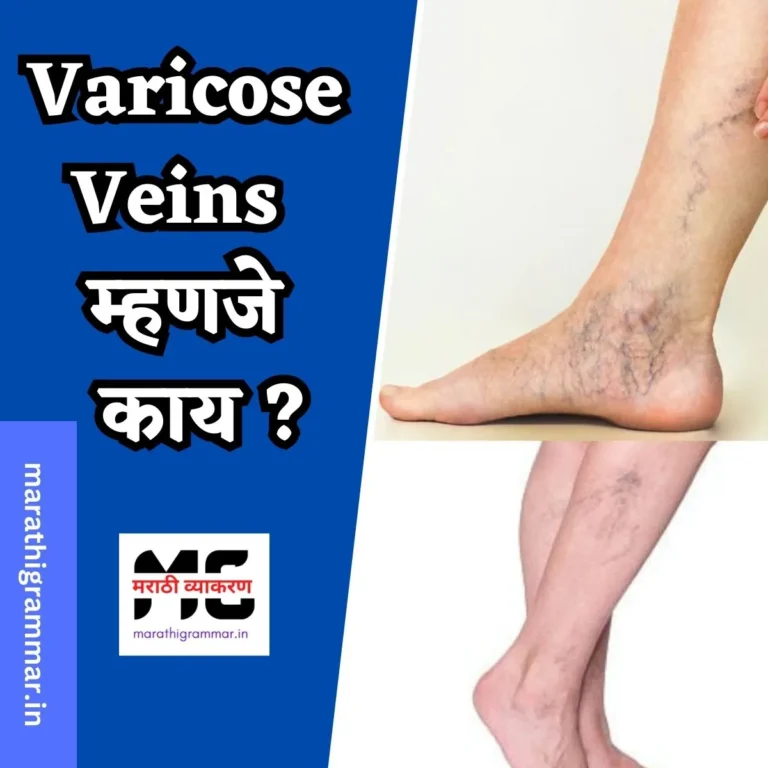 व्हेरिकोज व्हेन्स म्हणजे काय? | Varicose Veins in Marathi 